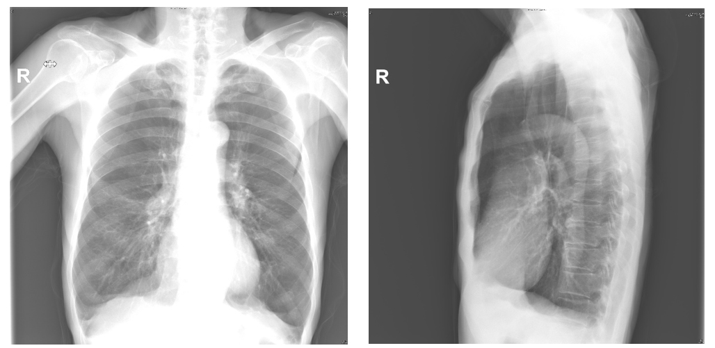 圖一、肺阻塞病人的胸部X光。左：後前照(PA view)；右：右側照(Right lateral view)